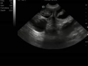 Ultrasound