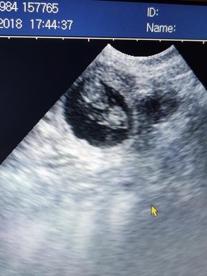 Scan at 4 weeks
