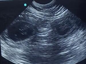 Ultrasound