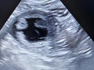 Ivy's ultrasound scan