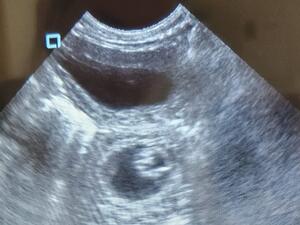 Ultrasound - Little sweetheart