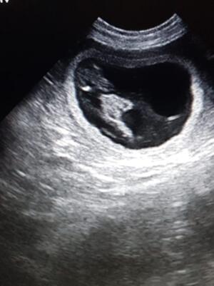 Pregnancy confirmed by ultrasound